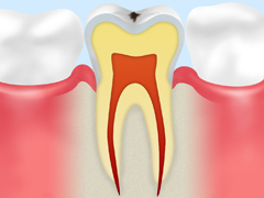CO 虫歯の前兆・ごく初期の虫歯