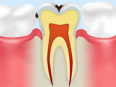 C1 エナメル質が溶けた虫歯
