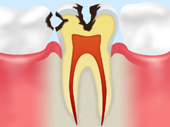 C2 象牙質が溶けた虫歯