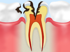 C3 歯髄まで達した虫歯