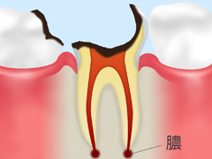 C4 歯冠を大きく失った虫歯