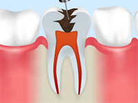 STEP1.神経・歯質の除去